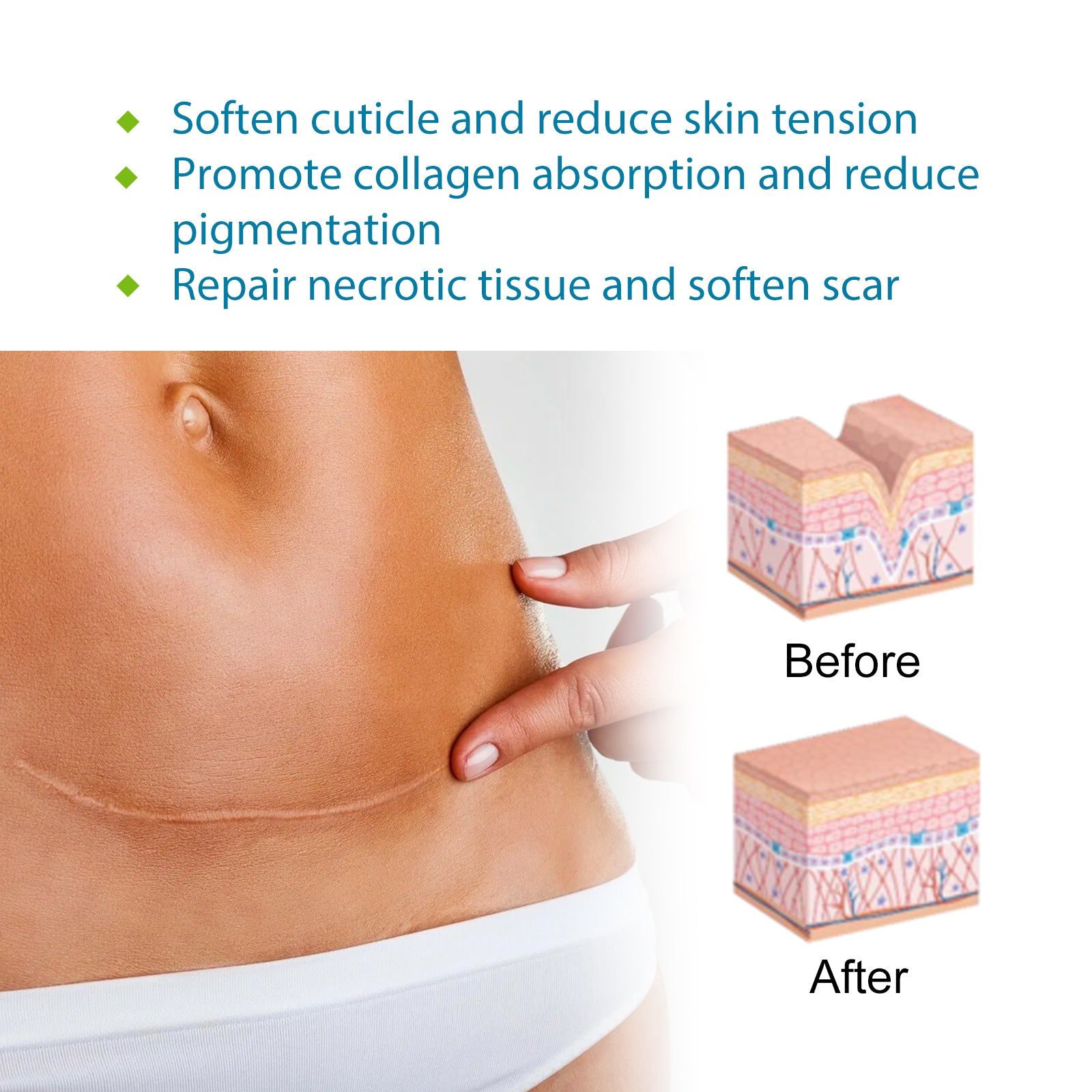 Self-Adhesive Silicone Scar Repair Orange Line Growth Line Smooth Skin Care Beauty Patch